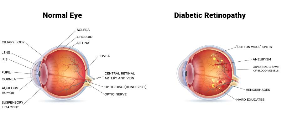 Diabetic Retinopathy