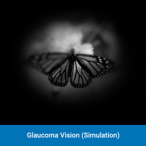 Glaucoma