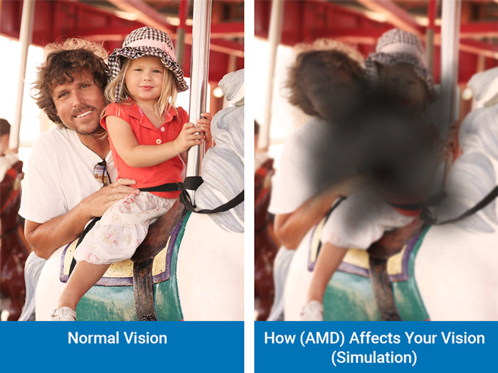 Macular Degeneration